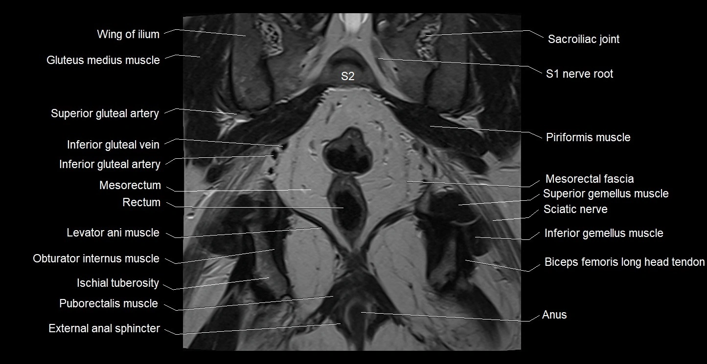 MRI coronal cross sectional anatomy male pelvis image 30.webp